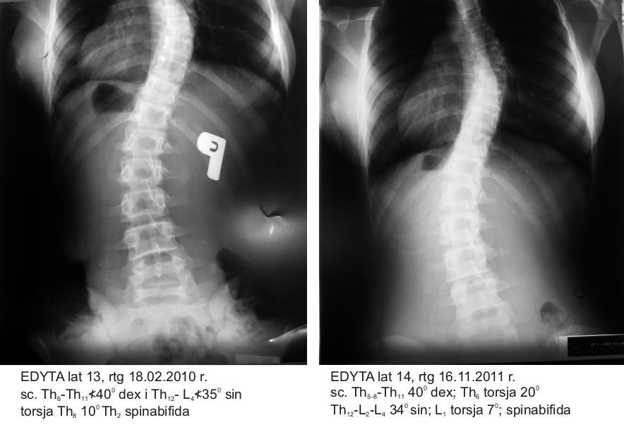 Przypadek 3. Przypadek 4. 3. E.K. 18.02.2010 r. Th 6 -Th 11 40 0 dex ur. 1997 r.