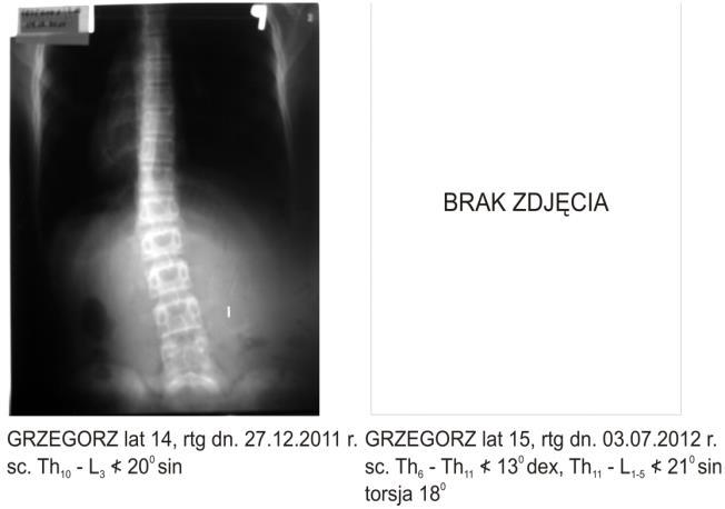 Przypadek 9 9. G.Ż. 27.12.2011 r. Th 10 -L 3 20 0 dex ur.