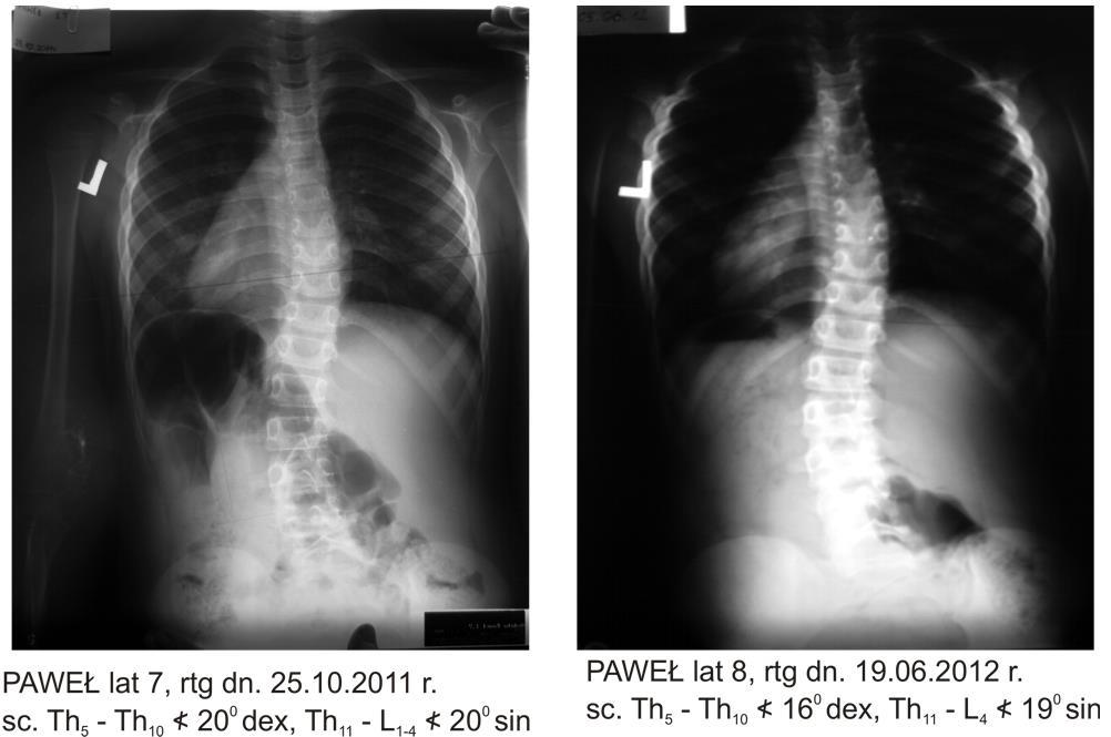 Th 5 -L 4 10 0 sin Przypadek 4 Lp. Imię i nazwisk Data RTG rozpoznanie zalecenia 4. P.O.