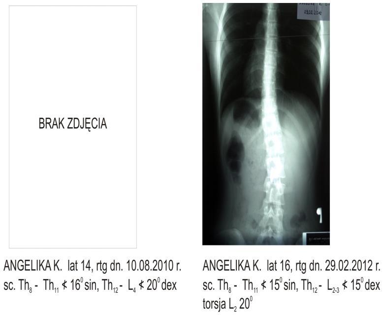 Przypadek 5 Lp. Imię i nazwisk Data RTG rozpoznanie zalecenia Przypadek 6 5. A.K. ur. 1996 r.