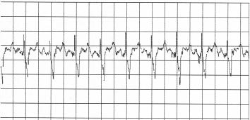 Folia Cardiol. 2001, tom 8, supl. A Tabela 2. Przyczyny zaburzeń świadomości stwierdzane za pomocą monitowania EKG przez telefon Table 2.