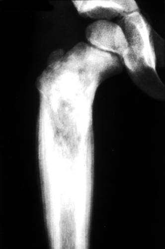 Sarcoma