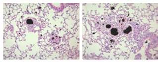 Ekspresja CHIT1 jako biomarker progresji choroby Organized granulomatous