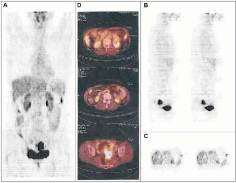 Applications of the positon emission tomography PET in oncologic gynecology 31 STAGING Ovarian cancer Clinical staging of the ovarian cancer is a major prognostic factor.