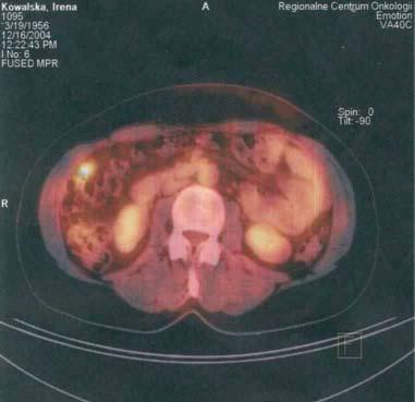 Przerzuty raka jajnika do miednicy mniejszej Fig. 4.