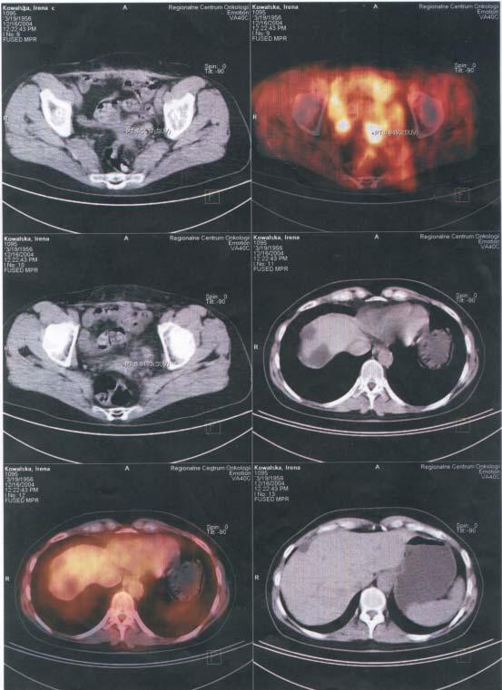 Przerzuty raka jajnika do miednicy mniejszej Fig. 5.