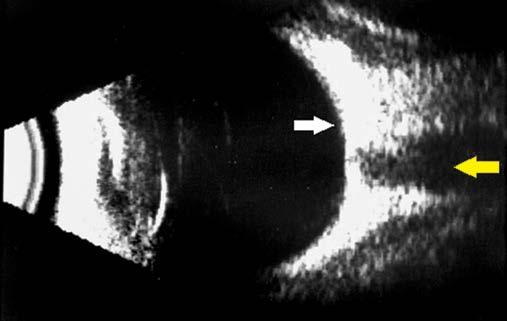 elementów jak: lokalizacja, kształt, granice i rozciągłość (prezentacja A + B); echografia ilościowa, oceniająca strukturę wewnętrzną zmiany, jej reflektywność i pochłanianie/osłabienie przez nią fal