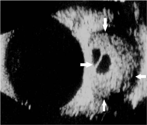 Zalecenia dotyczące badań ultrasonograficznych w okulistyce. Część II: Ultrasonografia oczodołu jak i podłużnym (czasem gruszkowaty kształt), o średniej echogeniczności i delikatnym zatarciu granic.