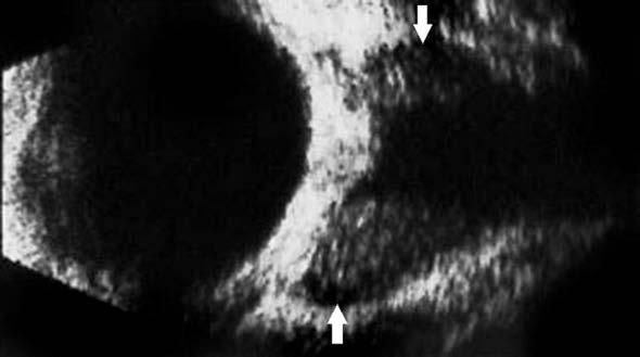 Małgorzata Karolczak-Kulesza, Małgorzata Rudyk, Magdalena Niestrata-Ortiz Ryc. 11. Oponiak nerwu obraz ultrasonograficzny w prezentacji B. Zarys guza oznaczono strzałkami schorzeniami oczodołowymi.