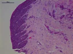 leksandra Opalińska et al., iopsja wycinająca zmiany barwnikowej macierzy paznokcia D E C F Rycina 8. Obraz histologiczny podpaznokciowej zmiany barwnikowej.