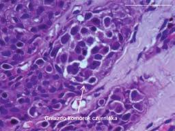 . Zbliżenie na gniazdo komórek nowotworowych (hematoksylina i eozyna, powiększenie x63). C.