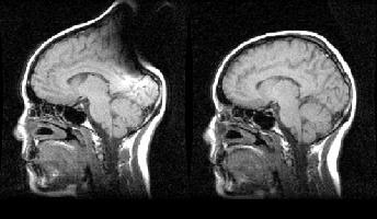 Zakłócenia w obrazach MR więcej o obrazowaniu MRI: https://www.imaios.