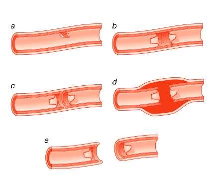 Rodzaje uszkodzeń naczyń Rozerwanie śródbłonka (a, b) częściowe (c) całkowite (d) uszkodzenie