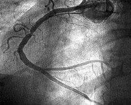 Case example of the negative vessel remodelling after balloon angioplasty.