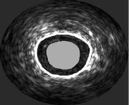 Control angiography 3 month after the precedure revealed occurrence of restenosis (C).