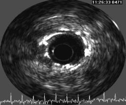 Control angiography as well as intravascular ultrasound 6 months after procedure revealed marked neointimal proliferation without vessel remodelling as a cause of diffuse in-stent restenosis leading