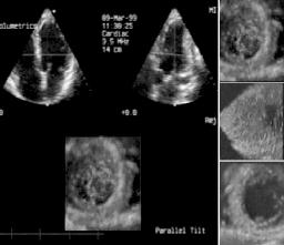 B. Firek, Zastosowanie echokardiografii trójwymiarowej Ryc. 4. W lewej części ryciny widoczne zdjęcie ekranu aparatu RTVR-3DE.