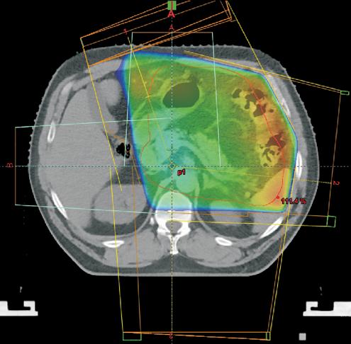 Obszar PTV wyznacza 1cm margines wokó³ CTV [13]. W pooperacyjnej radioterapii chorych na raka o³¹dka planowana dawka ca³kowita wynosi 45Gy w 25 frakcjach.