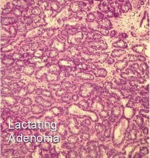 Histopatologia Histopatologicznie gruczolak laktacyjny jest dobrze ograniczoną zmianą, złożoną z płacików wydzielniczych, rozdzielonych delikatną tkanką łączną.