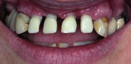 Wiadomo, iż ekstrakcja zębów, utrata podparcia kostnego, utrata punktów/płaszczyzn stycznych między zębami, a w konsekwencji stopniowa utrata brodawek są szczególnie widoczne, gdy pacjent traci