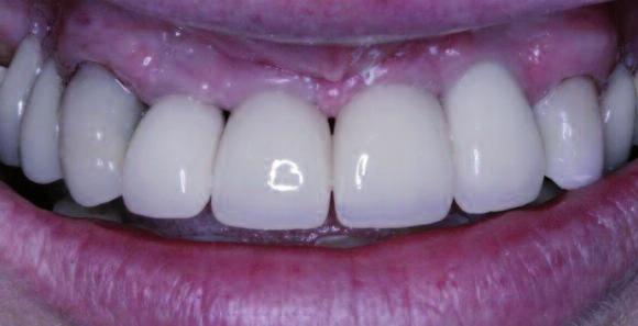 Ze względów estetycznych zamiast brakujących 5 zębów wykonano 4 korony. _Omówienie wyników i dyskusja Ryc.