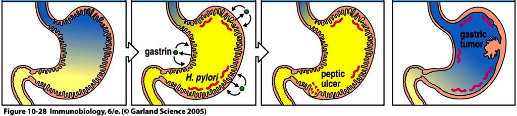 Helicobacter pylori w żołądku-rozwój nowotworu Sok żołądkowy utrzymuje kwaśne środowisko Obecność H.