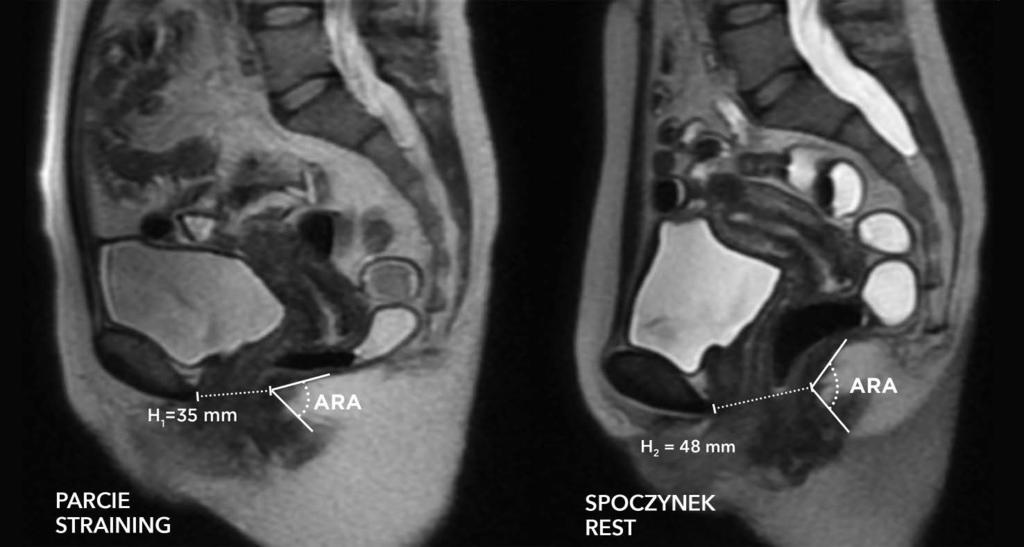 Monika Popiel a Ryc. 5a, b. Zespół spastycznego dna miednicy. Widoczne skrócenie linii H oraz paradoksalne zwężenie kąta ARA podczas parcia (a) w stosunku do fazy spoczynku (b) Fig. 5a, b. Spastic pelvic floor syndrome.