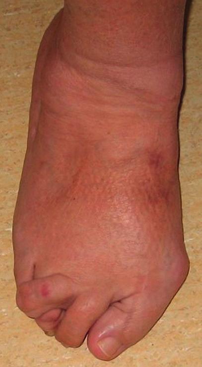 wykonać artrodezę techniką Lapidusa. C. Stan zapalny stopy i trudności w gojeniu. rak korekcji.