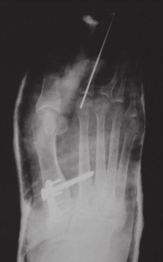 Radiogram pokazuje obluzowane zespolenie. E. Obraz kliniczny przed reoperacją. 23.