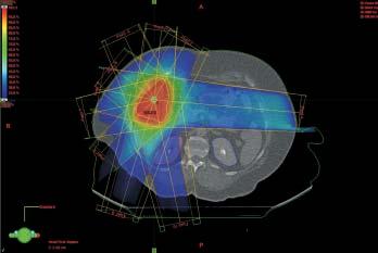 Initial assessment of tolerance and efficacy of local extracranial radiosurgery in patients with primary and metastasizing liver tumors 45 ation precision employing the MLC (multileaf collimator),