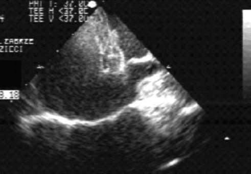 wewnątrznaczyniową sprężynką u 2, balonową angioplastykę rekoarktacji aorty u 1 oraz poszerzenie zwężonego ujścia lewej tętnicy płucnej za pomocą stentu typu Palmaz u 1.
