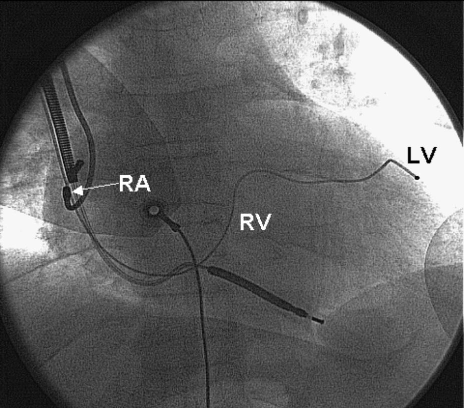 Sites for electrodes for cardiac resynchronisation and defibrillation system posterior-anterior view.