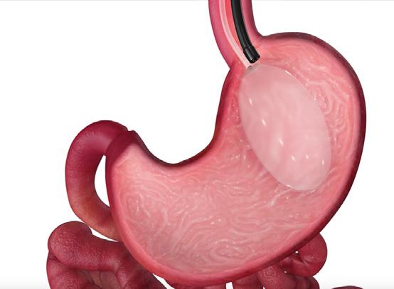Jak działa ORBERA365 Rozwiązanie niewymagające interwencji chirurgicznej 1 Pusty balon ORBERA wprowadzany jest przez usta