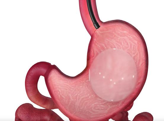aż osiągnie odpowiednią wielkość Po umiejscowieniu w żołądku balon ułatwia przyzwyczajenie się do mniejszych posiłków 12