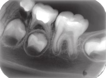 Wyd. 4, Williams&Wilkins. A Waverly Company, Baltimore 1994, rozdz. 19, 847-852. 3. Sonntag D., Kook K.: Leczenie endodontyczne zêbów mlecznych, Quintessence, 2002, 10, 6, 361-372. 4. Limanowska-Shaw H.