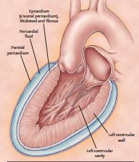 Zapalenie osierdzia-objawy kliniczne Zwiększenie objętości płynu w osierdziu może powodować: powiększenie sylwetki serca ból w klatce piersiowej ciche tony serca tarcie osierdzia bardzo zmienne, może