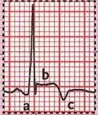 Zapalenie osierdzia EKG Duża objętość płynu w osierdziu może powodować zmiany takie jak: małą amplitudę zespołów QRS i załamków T naprzemienność elektryczną zespołów