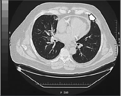 Zapalenie osierdzia - CT N