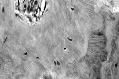 naczyniami) Komórki odontoblastopodobne mogą mieć charakter zbliżony do odontoblastów lub osteoblastów, a zębina naprawcza ma zaburzoną