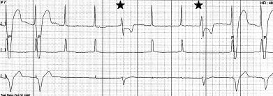 R. Baranowski i wsp., Zaburzenia stymulacji w codziennej praktyce pracowni 24 h EKG Ryc. 2. Stymulator VVI z elektrodą jednobiegunową, częstość podstawowa 65/min.