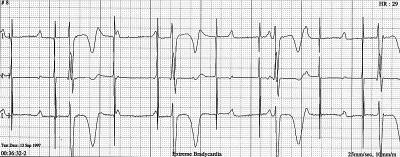 Oversensing in VVI pacemaker. Ryc. 3. Stymulator VVI o częstości 72/min. Okresowe zaburzenia stymulacji nieskuteczna stymulacja. W 3., 4., 6. i 7.