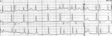 R. Baranowski i wsp., Zaburzenia stymulacji w codziennej praktyce pracowni 24 h EKG Ryc. 7. Fragment zapisu 24-godzinnego EKG u pacjenta ze stymulatorem AAI (60/min) oraz wywiadem kołatań.