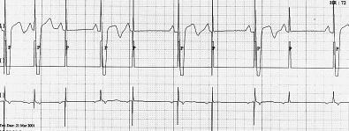 R. Baranowski i wsp., Zaburzenia stymulacji w codziennej praktyce pracowni 24 h EKG Ryc. 13. Stymulator VDD (65/min, bez histerezy, A-V 200 ms, maks. częstość stymulacji 120/min).