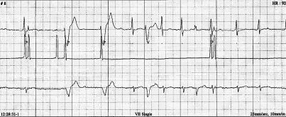 Stymulator DDD (65/min). W czasie rejestracji 24-godzinnego EKG napad migotania przedsionków. Nadal stymulacja DDD. W 1. ewolucji widoczne safety A-V delay, w 2. próba" stymulacji dwujamowej, w 3.