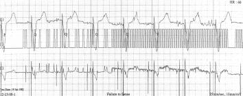 R. Baranowski i wsp., Zaburzenia stymulacji w codziennej praktyce pracowni 24 h EKG Ryc. 17. Zakłócenia zapisu pseudoimpulsy stymulatora rejestrowane w czasie korzystania z telefonu komórkowego. Fig.