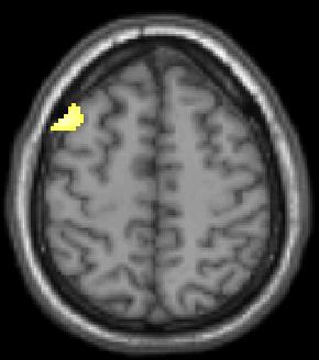 Middle Frontal Gyrus bilaterally