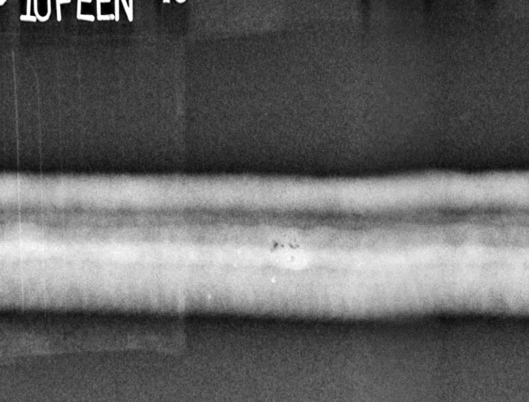 10 Radiogram cyfrowy spoiny W2 - potwierdzone wskazanie gniazda pęcherzy i pęcherzy kanalikowych (2013+2016) x 1= 42,5 43,5cm (0 taśmy - x= +1cm); Fig.