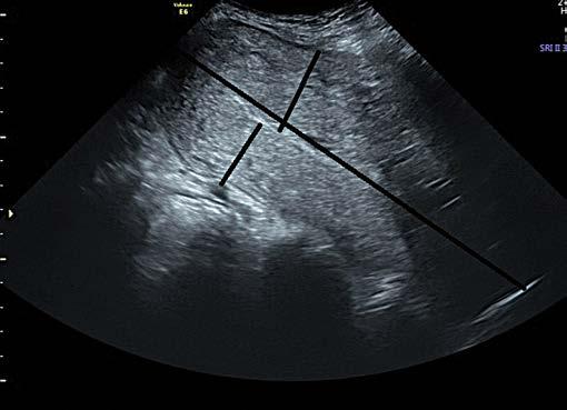Porównanie wyników badań ultrasonograficznych u pacjentek po niepowikłanym porodzie naturalnym i cięciu cesarskim Ryc. 1.