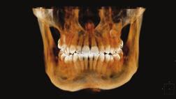 Tryb endodontyczny (dostępny dla pola obrazowania 5 x ø 5 cm) umożliwia