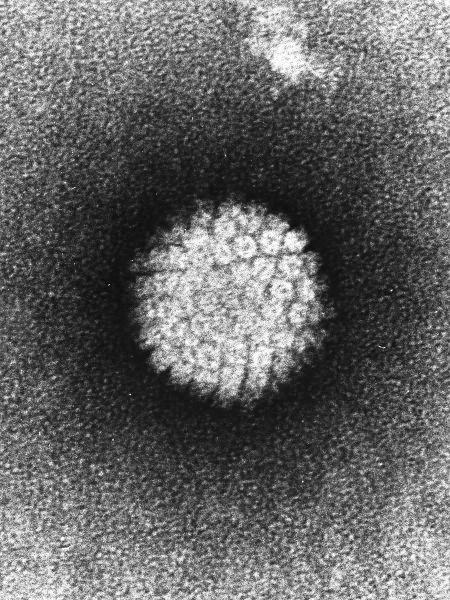 HPV i nowotwory Wirusy przenoszony drogą płciową Najczęstsze infekcje przenoszone tą drogą - ponad 50% dorosłych HPV typu 16 i 18 są istotnym czynnikiem ryzyka nowotworów 70%